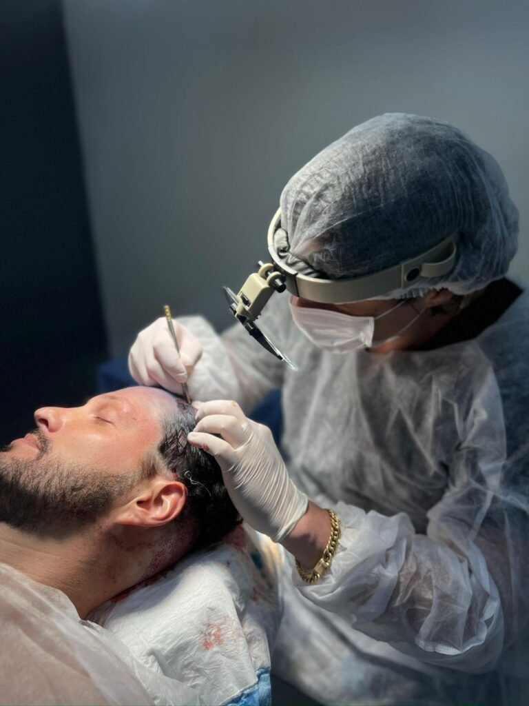 Procedimento de transplante capilar realizado pelo Dr. Leonardo Megale