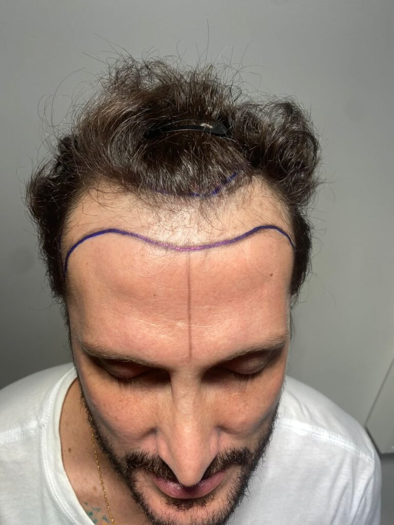 Procedimento de transplante capilar realizado pelo Dr. Leonardo Megale